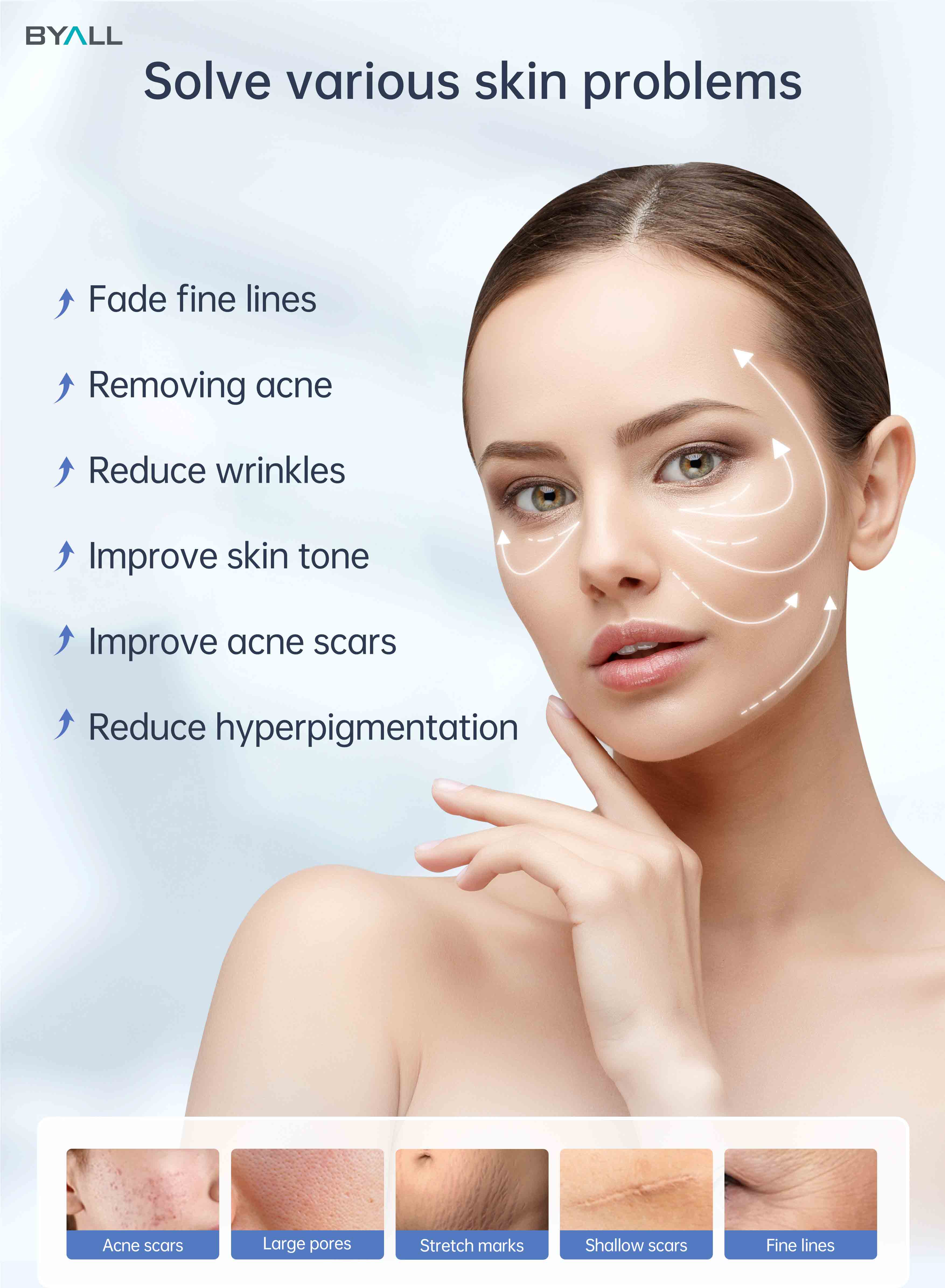 microneedling for stretch mark
