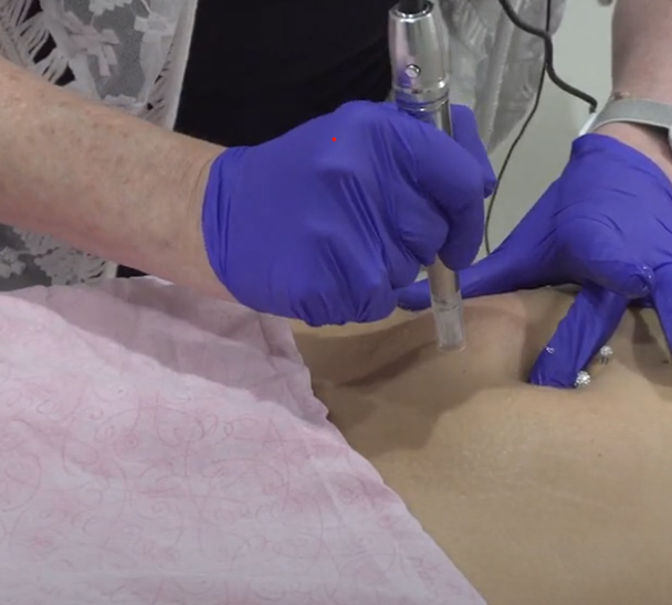 microneedling for stretch mark